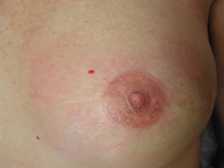 Tattoo nipple after cancer